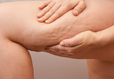 Celulitída očami medicíny, TCM a ajurvédy | LIPOELASTIC